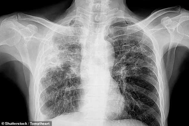 Health Officials Mobilize After TB Case at Leesville High School Sparks Resurgence Fears