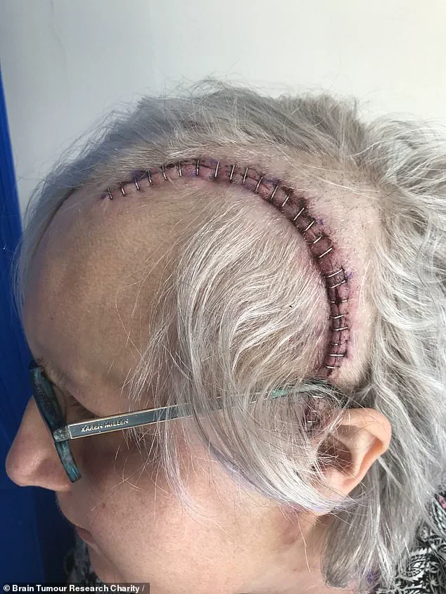 Misdiagnosis and Medical Urgency: The Hidden Brain Tumor Battle of a Retired Teacher