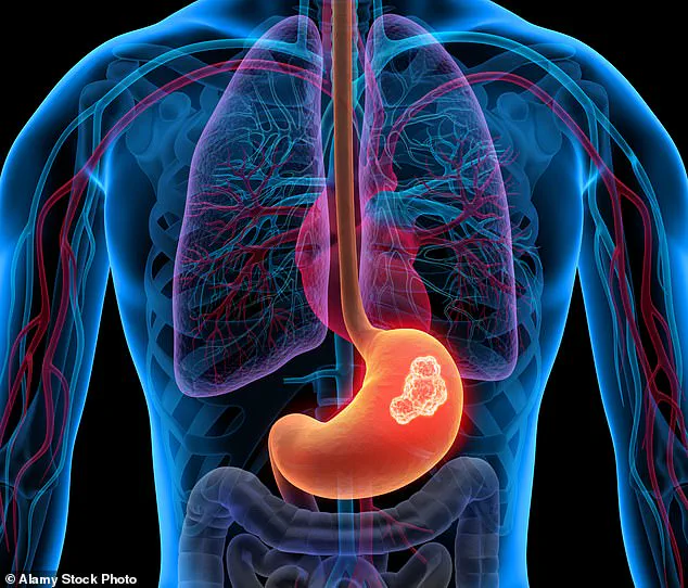 Persistent Heartburn Could Signal Life-Threatening Conditions, Warns Bristol GP