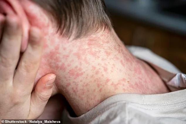 Robert F Kennedy Jr Shifts Stance, Endorses MMR Vaccine in Fight Against Measles