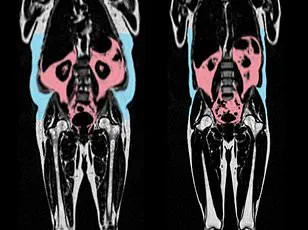 Study Reveals Underweight Individuals Face Higher Mortality Risk Than Overweight or Obese Peers