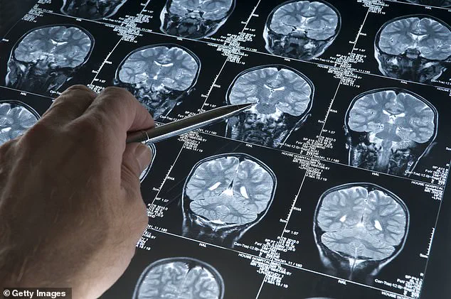 Misophonia's Emotional and Attention Roots: A New Understanding Offers Treatment Potential for 13 Million Americans