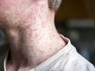 South Carolina Measles Outbreak: Exclusive Insights and Public Health Advisories from Experts