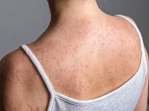 Measles Resurgence Sparks Alarm as US Faces Worst Crisis in Decades
