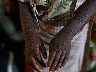 First Mpox Case in Alaska Since 2023 Confirmed; Health Officials Highlight Travel History and Public Health Measures