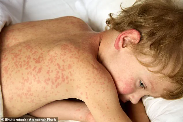 Measles Outbreak Sparks Health Alerts at Major US Airports, Experts Urge Vaccination Amid Rising Concerns