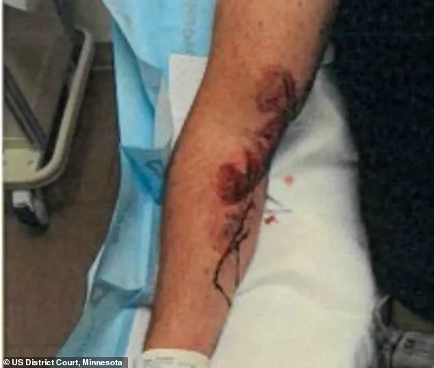 ICE Agent Jonathan Ross, Involved in Minneapolis Shooting, Shows Scars from Prior Dragging Incident in Court
