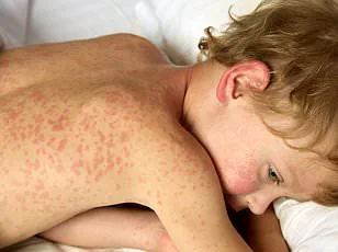 South Carolina Measles Outbreak Surges to 434 Cases Since September 2025, Prompting Health Officials to Warn of Rapid Spread in Unvaccinated Populations