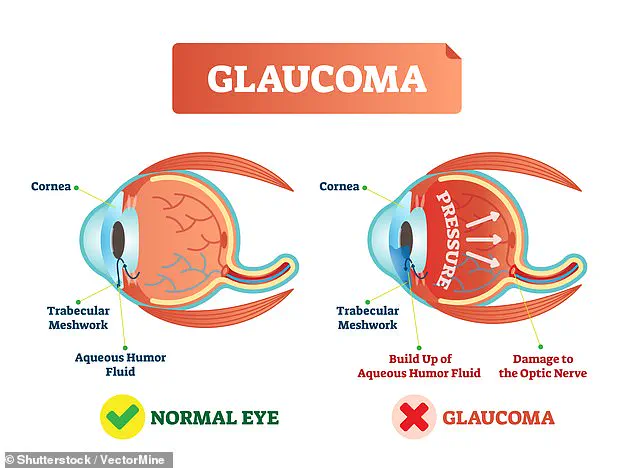 Over a Million in the UK Living with Glaucoma: Surge in Cases Raises Alarm Over Irreversible Blindness Risk