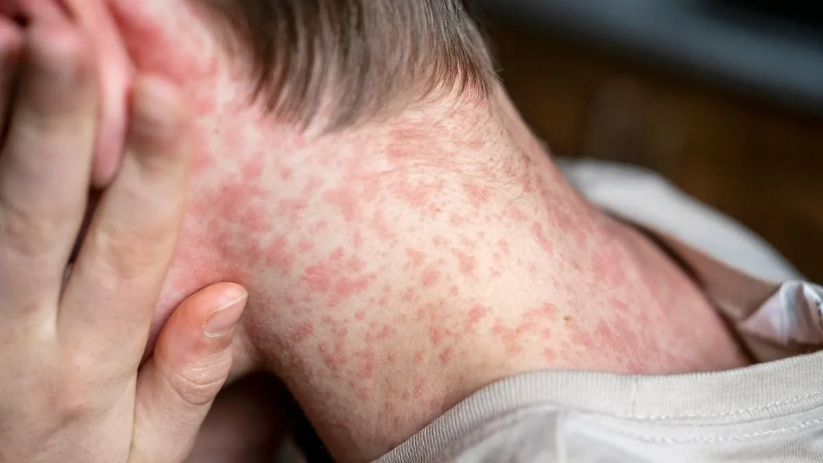 Chikungunya Resurgence Sparks Urgent CDC Travel Advisories as Cases Surge Globally