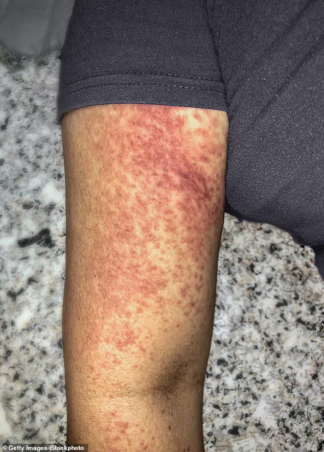 Chikungunya Resurgence Sparks Urgent CDC Travel Advisories as Cases Surge Globally
