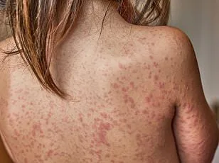 DC Officials Confirm Measles Cases, Warn of Exposure Risk After Rally