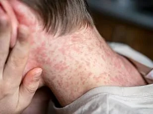 CDC Issues Urgent Warning as Chikungunya Resurgence Sparks Global Health Crisis