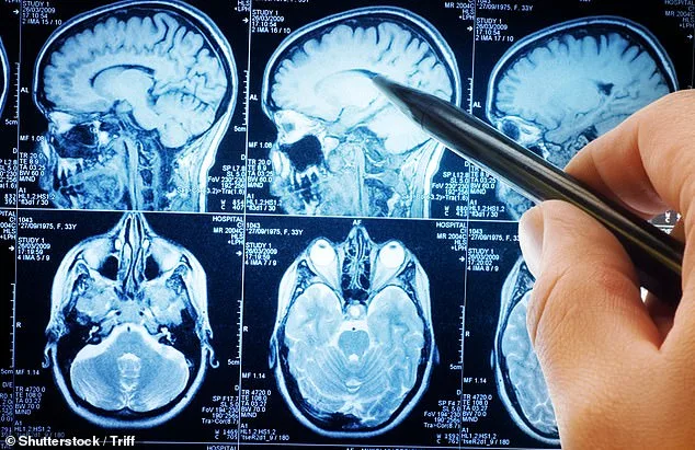 Beyond Tremors: Four Early Warning Signs of Parkinson's You Can't Ignore
