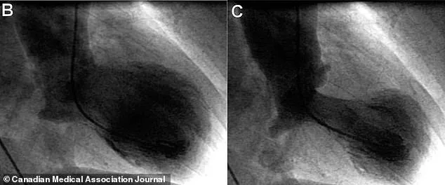 Newly Defined Broken Heart Syndrome Mimics Heart Attacks, Study Finds
