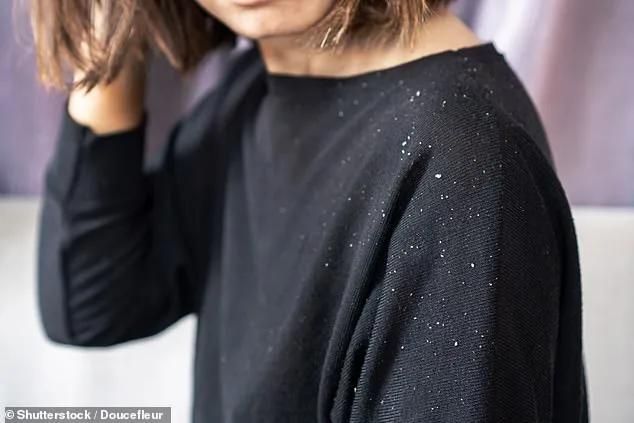 Seborrheic Dermatitis Soars: Microbial Shifts and Modern Living Fuel Public Health Crisis
