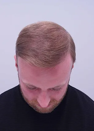 From Self-Consciousness to a Full Head of Hair: Alex Aitken's Journey to Confidence