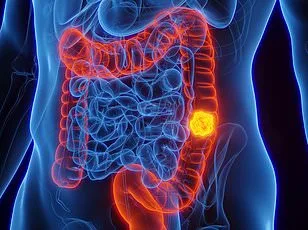 The Mouth as a Window to Bowel Cancer: Early Warning Signs in Oral Health