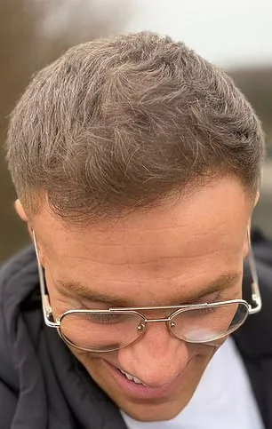 Baldness and Confidence: A Young Man's Battle with Hair Loss and the Tools He Used to Hide It