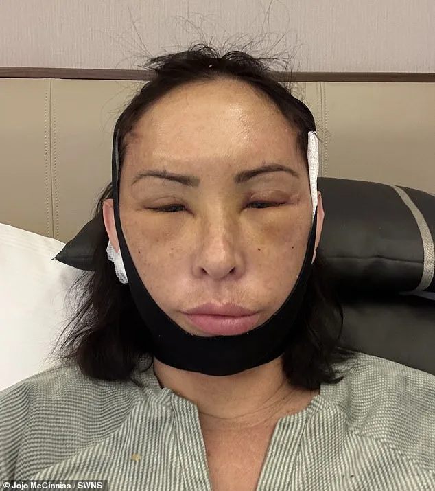 Over £10k Facelift in Turkey: Jojo McGinniss Faces Mixed Reactions After Transformative Surgery