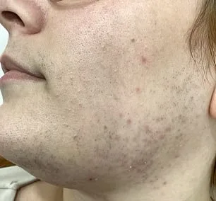 Hirsutism and PCOS: A Birmingham Woman's Relentless Daily Battle