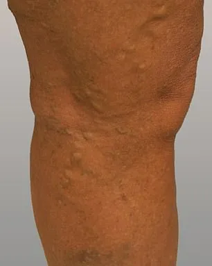 Philippa Bradley's Silent Battle: Varicose Veins and the Hidden Struggle of Millions