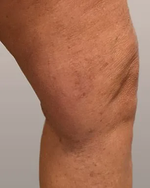 Philippa Bradley's Silent Battle: Varicose Veins and the Hidden Struggle of Millions