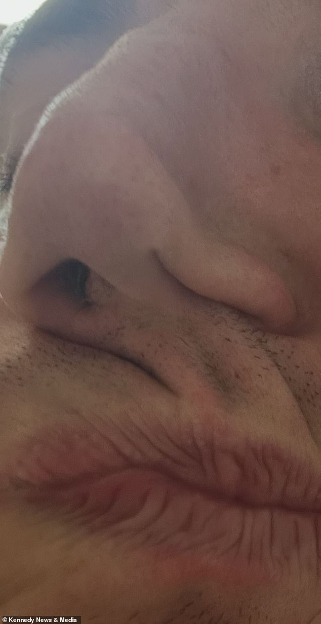 Cocaine addiction leaves father-to-be with permanent facial disfigurement and ruined finances.
