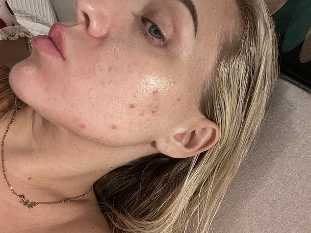 Doctor Recommends Off-Label Spironolactone for Acne After Accutane Fails